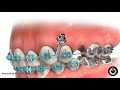 TAD for Mesializing Upper Molar | Dental Braces | Temecula Valley, CA