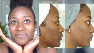 MY ACNE SKIN SCAR JOURNEY!