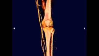 Venous Obstruction of the Thigh: Three-Dimensional View of Venous Thrombosis