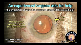 CataractCoach™1797: an experienced surgeon asks for help