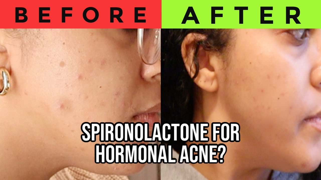 My 1 Month Experience On SPIRONOLACTONE For HORMONAL ACNE (BEFORE ...