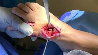 Foot \u0026 Ankle International - Modified Lapidus Procedure for Hallux Valgus