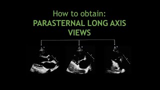 How to obtain: PARASTERNAL LONG AXIS VIEWS!