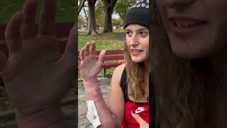 Nasty Wounds Due To Tranq \u0026 Fentanyl #addict #homeless #viral #trending