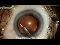 cataractcoach™1834 phaco section and hemi nucleus extraction