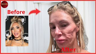 10 Plastic Surgery Disasters You Won’t Believe Happened | Celebrity Transformations Then & Now