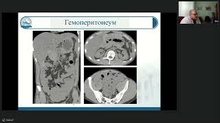 КТ при травме живота на примере клинических наблюдений