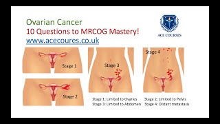 Ovarian Cancer for the MRCOG Exam. MRCOG Mastery in 10 Questions.