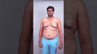 Gynecomastia surgery immediate result #shorts