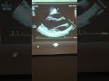 Complete Echocardiogram Protocol (Freshman Students)
