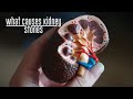 What Causes Kidney Stones - Dr. Rolando Rivera