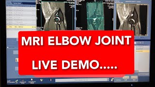 Elbow MRI scan protocol, positioning and planning on GE 1.5 Tesla | Live Demo.