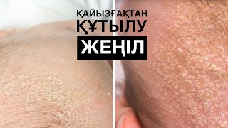 Нәрестенің басындағы қайызғақтан құтылу|Қаспақ кетіру