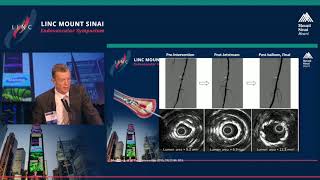 The Importance of Vessel Preparation To Optimize Outcomes of Peripheral Procedures