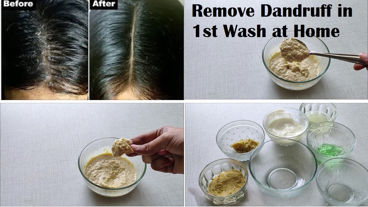 Best Remedy To Remove Dandruff Permanently And Naturally | How To Get ...