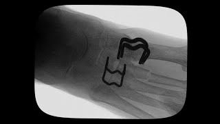 InstaFix™ Shape Memory Fixation System for LisFranc Repair with Samuel E Ford, MD