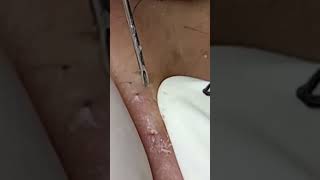 #blackheads #acne