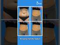 Abdomen Liposuction Before and After | After 360° Liposuction 6 Months Result #dramitgupta