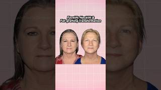 Facelift, Necklift, \u0026 Fat Grafting: Before \u0026 After Transformation | Dr. Wendy Wong #boardcertified