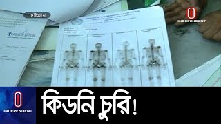 চিকিৎসার নামে কিডনি চুরি করে এক রোগীকে ... || Kidney Stealing