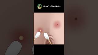 Pimples around belly button？Let's pop it! ASMR animation | Meng's Stop Motion