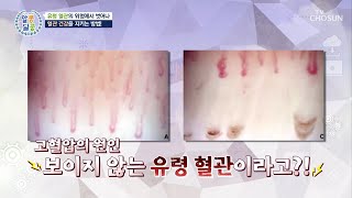 고혈압으로 인해 점점 사라져 목숨을 위협하는 유령 혈관😱 TV CHOSUN 241024 방송 | [알콩달콩] 256회 | TV조선