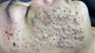 Big Cystic Acne Blackheads Extraction Blackheads \u0026 Milia, Whiteheads Removal Pimple Popping # 6819