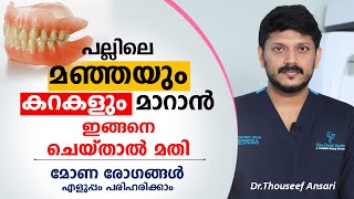 പല്ലിലെ കറകളും മഞ്ഞയും മാറാൻ ഇങ്ങനെ ചെയ്താൽ മതി | Dr.Thouseef Ansari | Oral Health