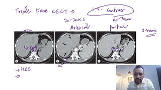 Triple phase CECT abdomen | Video No. 1 | NEET PG 2022