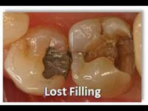 Emergency Dental Filling Emergency Dental Filling
