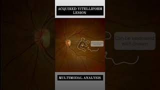 ACQUIRED VITELLIFORM LESION#optometrist #ophthalmology #retina #optometryadmissiontest #eyedisorder