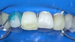 Esthetic rehabilitation of a wear case with compromised function