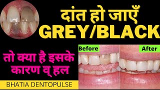 सामने का दांत ग्रे या काला हो जाये तो क्या करें-grey/black front tooth management-Dr. praveen Bhatia