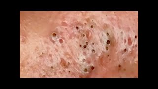 Satisfying Blackheads Removal Acne Treatment Big Blackheads Guide for You #349