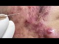 Big Cystic Acne Blackheads Extraction Blackheads & Milia, Whiteheads Removal part 1