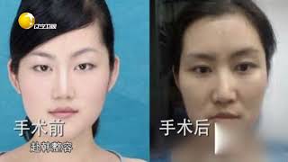 为了美女子千里迢迢赴韩整容，惨变毁容之旅，找谁说理！