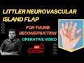 LITTLER FLAP | HETERODIGITAL NEUROVASCULAR ISLAND FLAP | THUMB RECONSTRUCTION