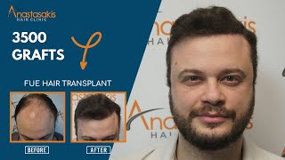 Amazing Hair Transformation: Stage 5, FUE \u0026 3500 grafts | 12 months after hair transplant-Case #287b