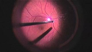 Leica RUV800 Vitrectomy in HD (partial clip)