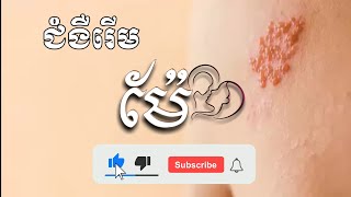 ជំងឺរើម