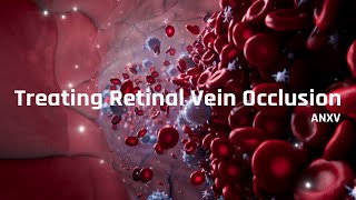 Treating Retinal Vein Occlusion (RVO)