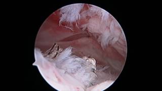 Massive cuff tear, revision, margin convergence 3