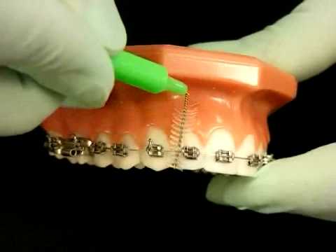 Bracesquestions.com - Brushing With Braces, How to Brush Teeth Bracesquestions.com - Brushing With Braces, How to Brush Teeth