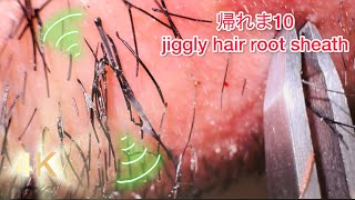 【4K】毛根鞘10本抜けるまで終われない！（右顎髭）can't finish until 10hair root sheath fall out! （right）