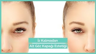 İzsiz Alt Göz Kapağı Estetiği | Alt Göz Kapağı (Animasyonlu Anlatım) | Dr. Erdem Güven