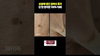 손등에 생긴 검버섯 흑자 단 한번이면 100%치료!?#리팟 #검버섯없애기 #흑자없애기