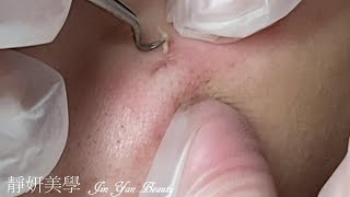 臉頰閉鎖性粉刺(Closed acne)-Taiwan New Taipei City-大台北清粉刺最乾淨