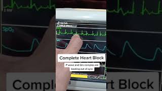 Ecg in complete Heart block | Quick Health Tips by Dr.Paramjeet