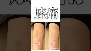 【膝痛（変形性膝関節症）before  after 】早期施術で炎症を止めよう‼︎本来の治癒力を生かそう‼︎