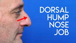 Dorsal Hump Nose Job